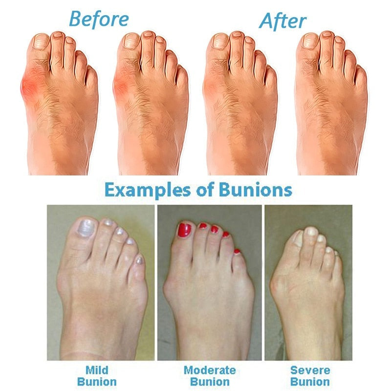 Comfortable Arch Support Bunion Relief Sandals