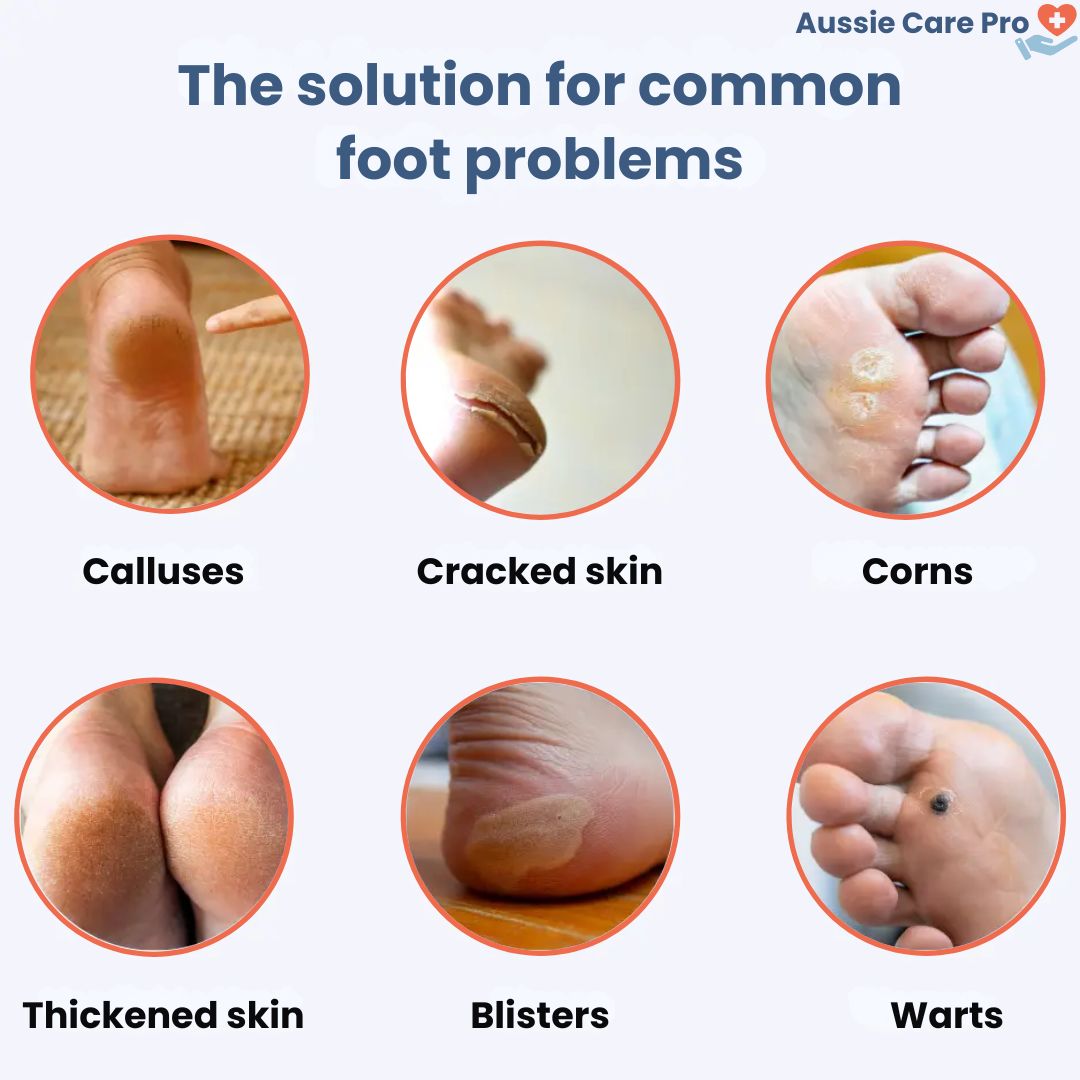 Easy Electric Foot Callus Remover