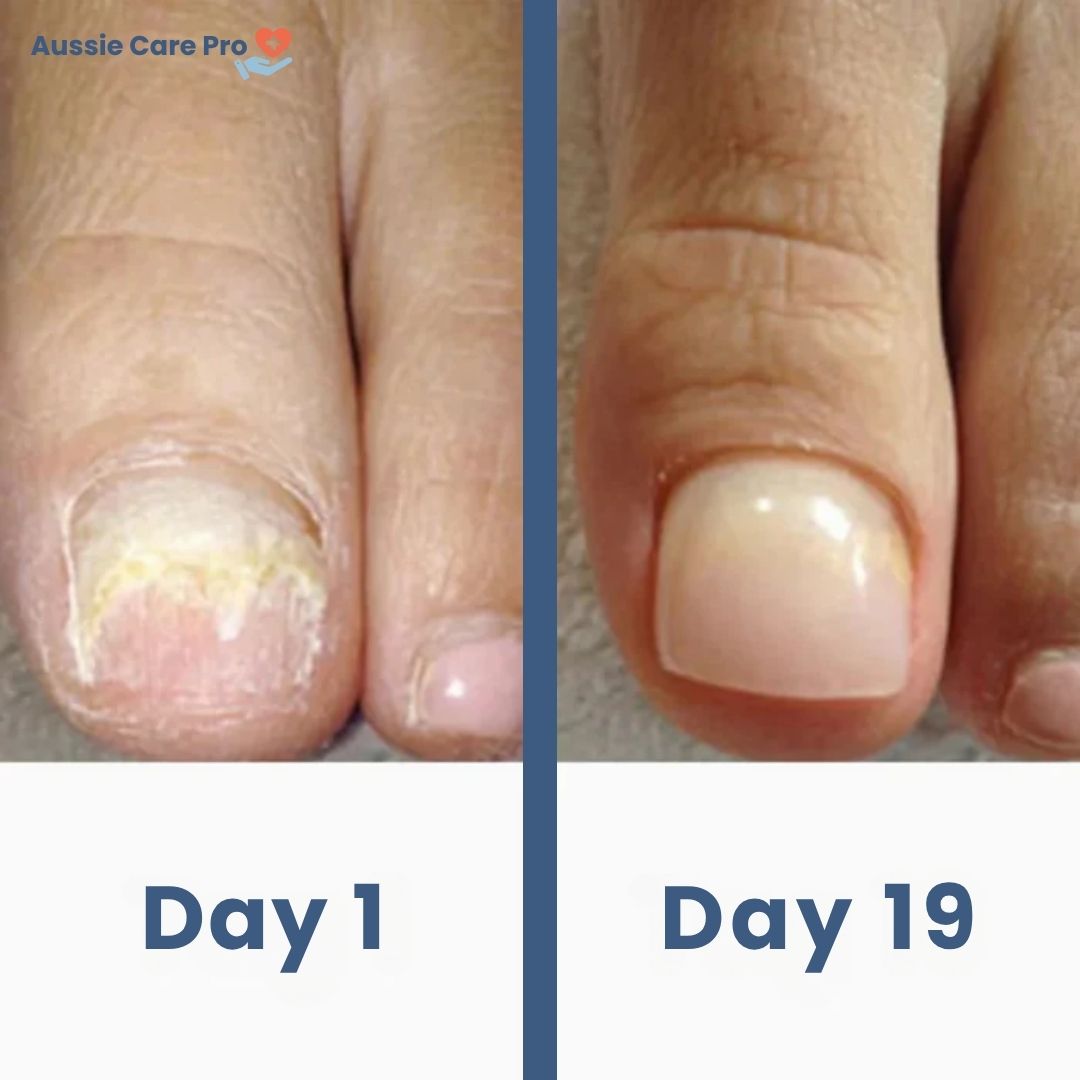 Effective At Home Fungus Nail Remedy