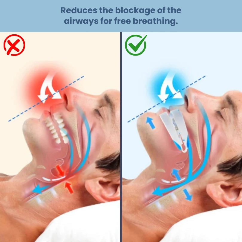 Snore Reducing Jaw Support Mouthpiece – Silent Sleep Aid