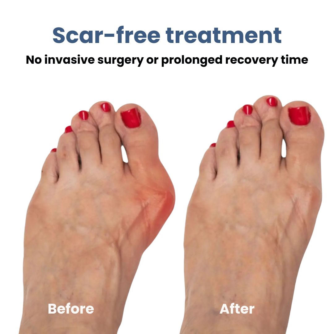 Comfortable Bunion Corrector Support