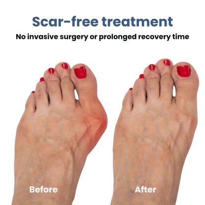 Comfortable Bunion Corrector Support