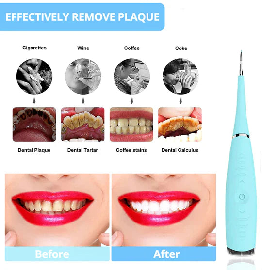 Tartar Removal Tooth Tool
