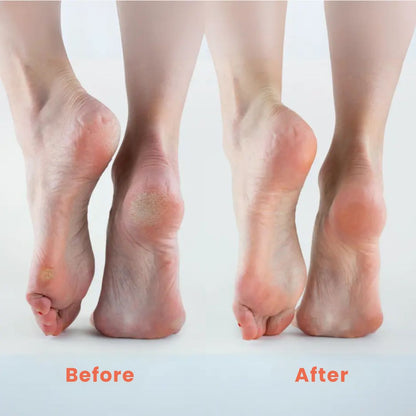Easy Electric Foot Callus Remover