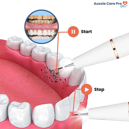 Advanced Dental Plaque Remover for Cleaner Teeth