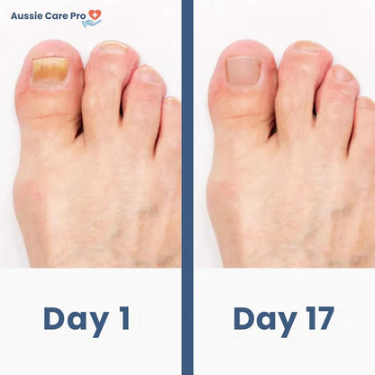 Effective At Home Fungus Nail Remedy