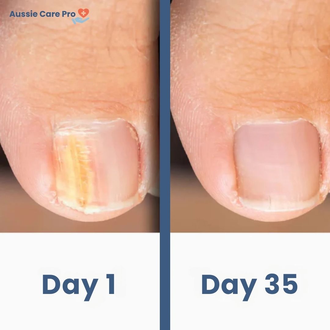 Effective At Home Fungus Nail Remedy