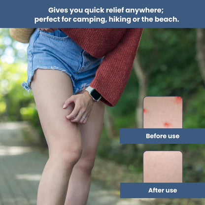 Fast Itch Relief for Bug Bites