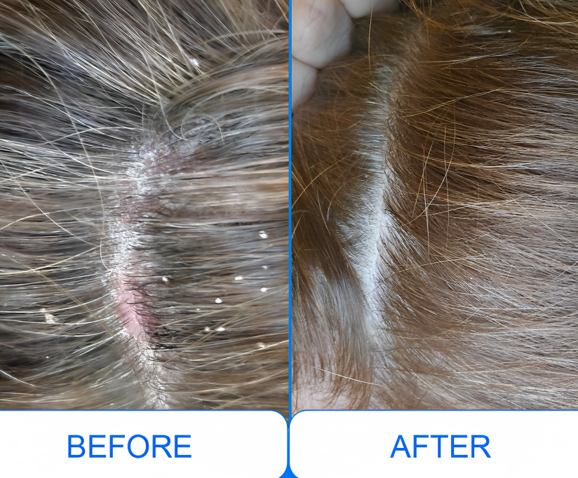 Cordless UVB lamp for at-home skin therapy, medium 5x2" area, LED screen, non-invasive treatment for psoriasis and eczema.